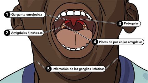 infeccion de garganta por estreptococo